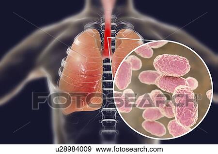 Whooping cough, conceptual illustration. Whooping cough is a highly contagious infectious disease caused by Bordetella pertussis bacteria. The main symptoms are paroxysms of cough and inspiratory whoop. B. pertussis are gram-negative, aerobic,... View Large Photo Image Stock Photo - Whooping cough, conceptual illustration. Whooping cough is a highly contagious infectious disease caused by Bordetella pertussis bacteria. The main symptoms are paroxysms of cough and inspiratory whoop. B. pertussis are gram-negative, aerobic,.... Fotosearch