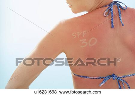 Woman with sunburnt back and 'SPF 30' written on her shoulder. View Large Photo Image Stock Photo - Woman with sunburnt back and 'SPF 30' written on her shoulder.. Fotosearch