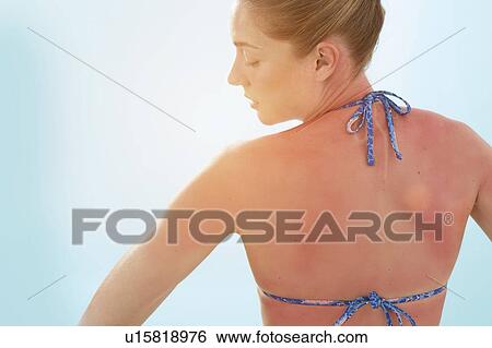 Stock Photograph - Woman with sunburnt back, rear view.. Fotosearch
