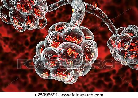 Stock Image - Bacterial pneumonia. Computer illustration of rod-shaped bacteria (bacilli) inside the alveoli of the lungs, causing a lower respiratory tract infection. This is more generally known as pneumonia, though that term can also be reserved for specific.... Fotosearch