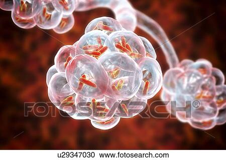 Stock Image - Bacterial pneumonia. Computer illustration of rod-shaped bacteria (bacilli) inside the alveoli of the lungs, causing a lower respiratory tract infection. This is more generally known as pneumonia, though that term can also be reserved for specific.... Fotosearch