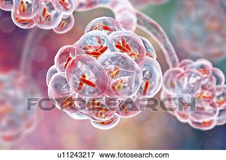 Stock Photo - Bacterial pneumonia. Computer illustration of rod-shaped bacteria (bacilli) inside the alveoli of the lungs, causing a lower respiratory tract infection. This is more generally known as pneumonia, though that term can also be reserved for specific.... Fotosearch