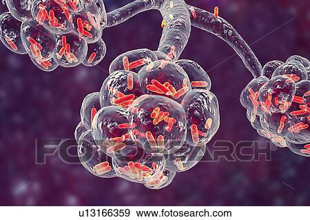 Stock Photo - Bacterial pneumonia. Computer illustration of rod-shaped bacteria (bacilli) inside the alveoli of the lungs, causing a lower respiratory tract infection. This is more generally known as pneumonia, though that term can also be reserved for specific.... Fotosearch