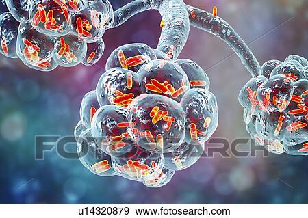 Stock Photo - Bacterial pneumonia. Computer illustration of rod-shaped bacteria (bacilli) inside the alveoli of the lungs, causing a lower respiratory tract infection. This is more generally known as pneumonia, though that term can also be reserved for specific.... Fotosearch