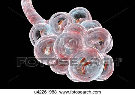 Bacterial pneumonia. Computer illustration of rod-shaped bacteria (bacilli) inside the alveoli of the lungs, causing a lower respiratory tract infection. This is more generally known as pneumonia, though that term can also be reserved for specific... View Large Photo Image Stock Photo - Bacterial pneumonia. Computer illustration of rod-shaped bacteria (bacilli) inside the alveoli of the lungs, causing a lower respiratory tract infection. This is more generally known as pneumonia, though that term can also be reserved for specific.... Fotosearch