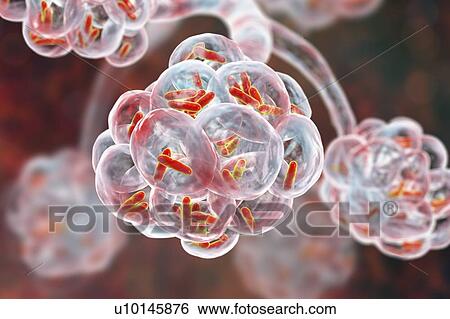 Stock Photograph - Bacterial pneumonia. Computer illustration of rod-shaped bacteria (bacilli) inside the alveoli of the lungs, causing a lower respiratory tract infection. This is more generally known as pneumonia, though that term can also be reserved for specific.... Fotosearch