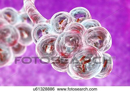 Bacterial pneumonia. Computer illustration of rod-shaped bacteria (bacilli) inside the alveoli of the lungs, causing a lower respiratory tract infection. This is more generally known as pneumonia, though that term can also be reserved for specific... View Large Photo Image Stock Photograph - Bacterial pneumonia. Computer illustration of rod-shaped bacteria (bacilli) inside the alveoli of the lungs, causing a lower respiratory tract infection. This is more generally known as pneumonia, though that term can also be reserved for specific.... Fotosearch