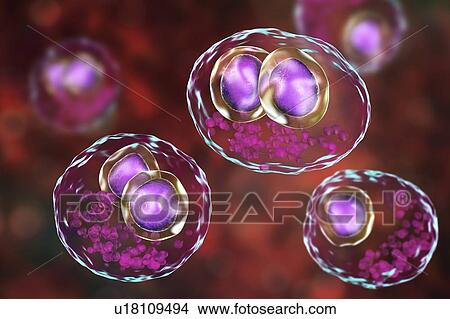 Picture - Cytomegalovirus infection. Computer illustration of human cells showing cytomegalic inclusion disease, a symptom of cytomegalovirus infection. Cytomegalovirus (CMV) particles invade cell nuclei, causing the appearance of darker bodies within them.... Fotosearch