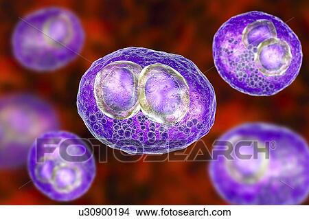 Picture - Cytomegalovirus infection. Computer illustration of human cells showing cytomegalic inclusion disease, a symptom of cytomegalovirus infection. Cytomegalovirus (CMV) particles invade cell nuclei, causing the appearance of darker bodies within them.... Fotosearch