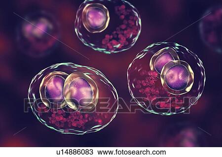 Stock Image - Cytomegalovirus infection. Computer illustration of human cells showing cytomegalic inclusion disease, a symptom of cytomegalovirus infection. Cytomegalovirus (CMV) particles invade cell nuclei, causing the appearance of darker bodies within them.... Fotosearch