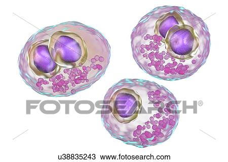 Stock Image - Cytomegalovirus infection. Computer illustration of human cells showing cytomegalic inclusion disease, a symptom of cytomegalovirus infection. Cytomegalovirus (CMV) particles invade cell nuclei, causing the appearance of darker bodies within them.... Fotosearch