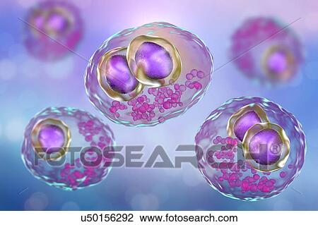 Stock Image - Cytomegalovirus infection. Computer illustration of human cells showing cytomegalic inclusion disease, a symptom of cytomegalovirus infection. Cytomegalovirus (CMV) particles invade cell nuclei, causing the appearance of darker bodies within them.... Fotosearch