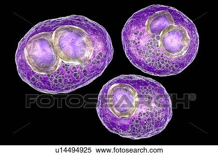 Stock Photography - Cytomegalovirus infection. Computer illustration of human cells showing cytomegalic inclusion disease, a symptom of cytomegalovirus infection. Cytomegalovirus (CMV) particles invade cell nuclei, causing the appearance of darker bodies within them.... Fotosearch