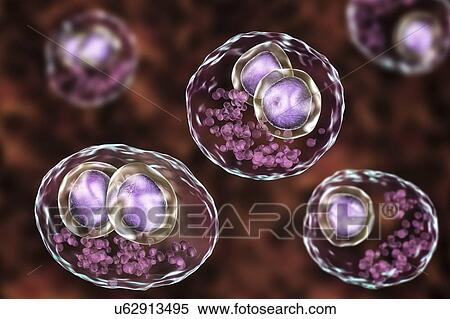 Stock Photography - Cytomegalovirus infection. Computer illustration of human cells showing cytomegalic inclusion disease, a symptom of cytomegalovirus infection. Cytomegalovirus (CMV) particles invade cell nuclei, causing the appearance of darker bodies within them.... Fotosearch