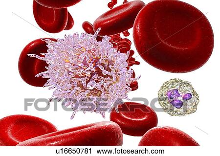 Stock Image - Hairy cell leukaemia. Computer illustration of abnormal white blood cell (B- lymphocyte) from a patient with hairy cell leukaemia. These cells show characteristic hair-like cytoplasmic projections and ruffles on their surfaces. Leukaemia is a blood.... Fotosearch