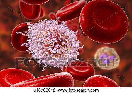 Stock Image - Hairy cell leukaemia. Computer illustration of abnormal white blood cell (B- lymphocyte) from a patient with hairy cell leukaemia. These cells show characteristic hair-like cytoplasmic projections and ruffles on their surfaces. Leukaemia is a blood.... Fotosearch