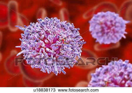 Stock Image - Hairy cell leukaemia. Computer illustration of abnormal white blood cell (B- lymphocyte) from a patient with hairy cell leukaemia. These cells show characteristic hair-like cytoplasmic projections and ruffles on their surfaces. Leukaemia is a blood.... Fotosearch