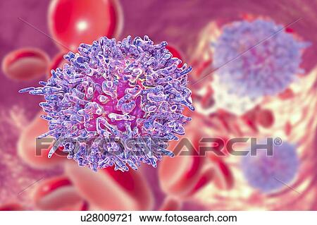 Hairy cell leukaemia. Computer illustration of abnormal white blood cell (B- lymphocyte) from a patient with hairy cell leukaemia. These cells show characteristic hair-like cytoplasmic projections and ruffles on their surfaces. Leukaemia is a blood... View Large Photo Image Stock Image - Hairy cell leukaemia. Computer illustration of abnormal white blood cell (B- lymphocyte) from a patient with hairy cell leukaemia. These cells show characteristic hair-like cytoplasmic projections and ruffles on their surfaces. Leukaemia is a blood.... Fotosearch