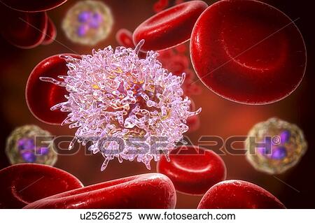 Stock Photography - Hairy cell leukaemia. Computer illustration of abnormal white blood cell (B- lymphocyte) from a patient with hairy cell leukaemia. These cells show characteristic hair-like cytoplasmic projections and ruffles on their surfaces. Leukaemia is a blood.... Fotosearch