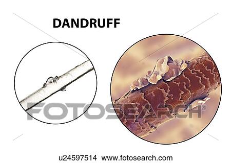 Picture - Human hair with dandruff, computer illustration and light micrograph.. Fotosearch
