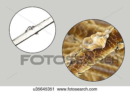 Human hair with dandruff, computer illustration and light micrograph. View Large Photo Image Stock Image - Human hair with dandruff, computer illustration and light micrograph.. Fotosearch