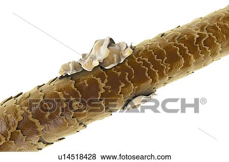 Stock Photo - Human hair with dandruff, computer illustration.. Fotosearch