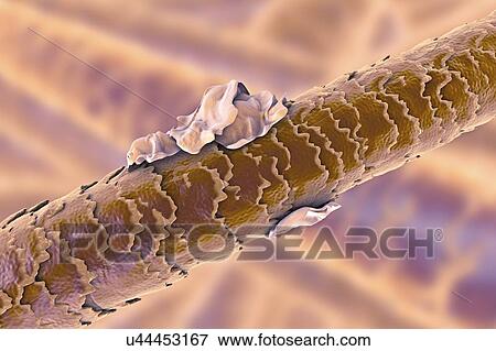 Stock Photo - Human hair with dandruff, computer illustration.. Fotosearch
