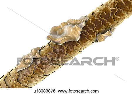 Human hair with dandruff, computer illustration. View Large Photo Image Stock Photograph - Human hair with dandruff, computer illustration.. Fotosearch