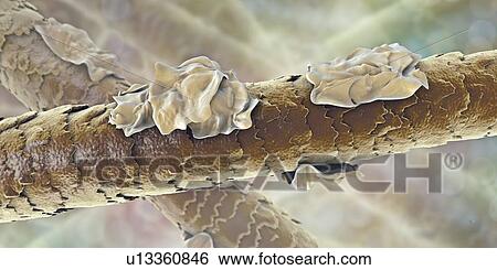 Stock Photograph - Human hair with dandruff, computer illustration.. Fotosearch