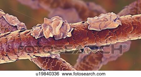 Stock Photograph - Human hair with dandruff, computer illustration.. Fotosearch