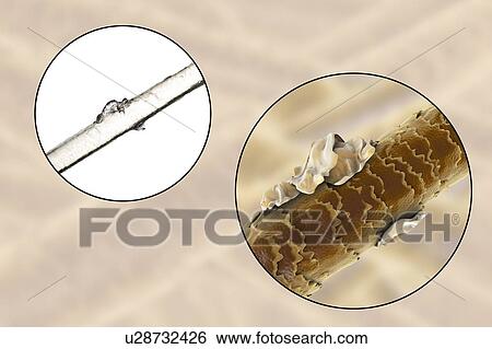 Stock Photograph - Human hair with dandruff, computer illustration and light micrograph.. Fotosearch