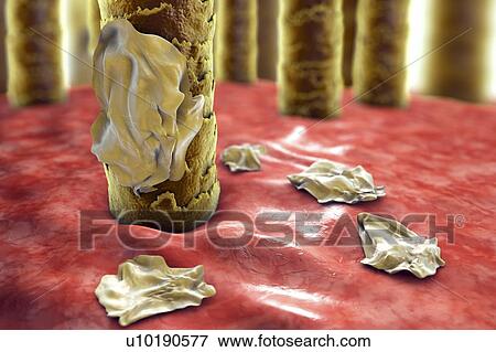 Human scalp with dandruff, computer illustration. View Large Photo Image Stock Photo - Human scalp with dandruff, computer illustration.. Fotosearch
