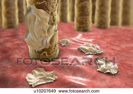 Stock Photo - Human scalp with dandruff, computer illustration.. Fotosearch