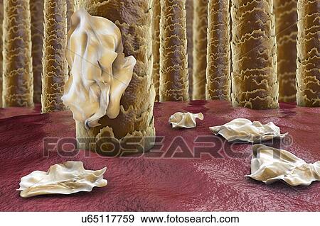 Stock Photo - Human scalp with dandruff, computer illustration.. Fotosearch