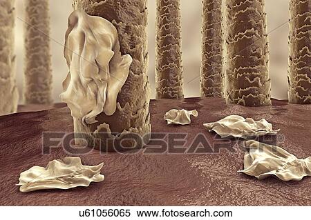 Stock Photography - Human scalp with dandruff, computer illustration.. Fotosearch