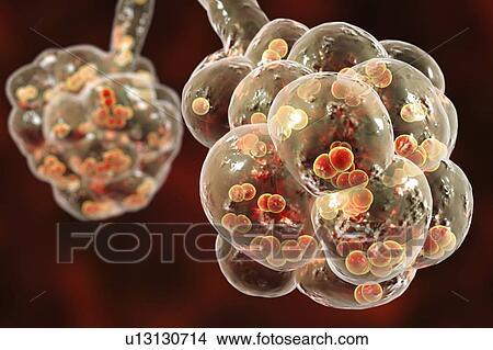 Picture - Pneumococcal pneumonia. Computer illustration of Streptococcus pneumoniae (pneumococci) bacteria inside the alveoli of the lungs, causing pneumonia.. Fotosearch