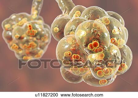 Stock Image - Pneumococcal pneumonia. Computer illustration of Streptococcus pneumoniae (pneumococci) bacteria inside the alveoli of the lungs, causing pneumonia.. Fotosearch