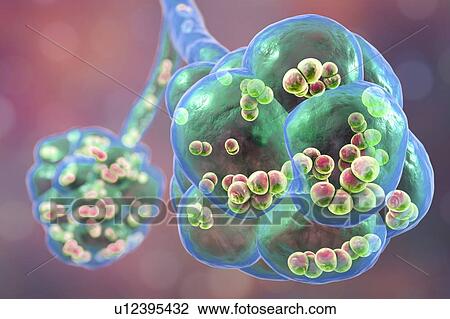 Pneumococcal pneumonia. Computer illustration of Streptococcus pneumoniae (pneumococci) bacteria inside the alveoli of the lungs, causing pneumonia. View Large Photo Image Stock Image - Pneumococcal pneumonia. Computer illustration of Streptococcus pneumoniae (pneumococci) bacteria inside the alveoli of the lungs, causing pneumonia.. Fotosearch