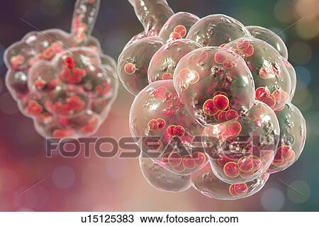 Pneumococcal pneumonia. Computer illustration of Streptococcus pneumoniae (pneumococci) bacteria inside the alveoli of the lungs, causing pneumonia. View Large Photo Image Stock Image - Pneumococcal pneumonia. Computer illustration of Streptococcus pneumoniae (pneumococci) bacteria inside the alveoli of the lungs, causing pneumonia.. Fotosearch