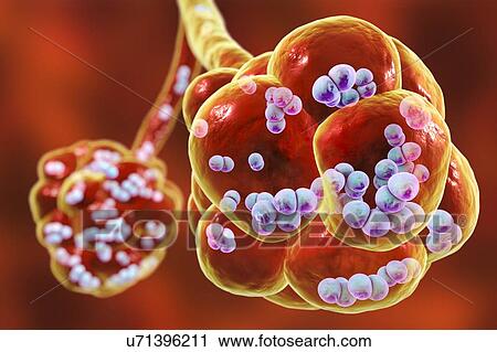 Stock Image - Pneumococcal pneumonia. Computer illustration of Streptococcus pneumoniae (pneumococci) bacteria inside the alveoli of the lungs, causing pneumonia.. Fotosearch