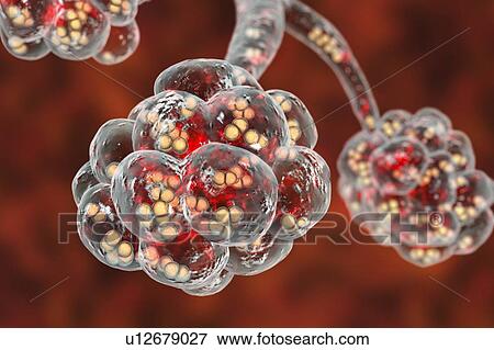 Pneumococcal pneumonia. Computer illustration of Streptococcus pneumoniae (pneumococci) bacteria inside the alveoli of the lungs, causing pneumonia. View Large Photo Image Stock Photo - Pneumococcal pneumonia. Computer illustration of Streptococcus pneumoniae (pneumococci) bacteria inside the alveoli of the lungs, causing pneumonia.. Fotosearch