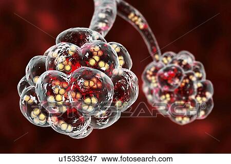Stock Photo - Pneumococcal pneumonia. Computer illustration of Streptococcus pneumoniae (pneumococci) bacteria inside the alveoli of the lungs, causing pneumonia.. Fotosearch