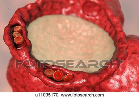 Stock Image - Pulmonary edema, computer illustration. The capillaries have become congested with red blood cells (erythrocytes, round) and dilated, and the alveoli (air spaces) have filled with fluid. The presence of fluid in the lungs interferes with gaseous.... Fotosearch