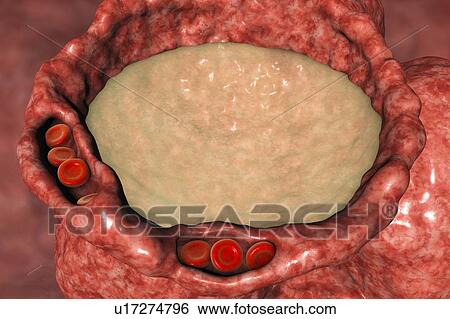 Stock Photograph - Pulmonary edema, computer illustration. The capillaries have become congested with red blood cells (erythrocytes, round) and dilated, and the alveoli (air spaces) have filled with fluid. The presence of fluid in the lungs interferes with gaseous.... Fotosearch