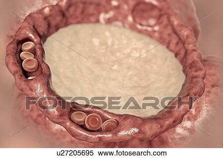 Stock Photography - Pulmonary edema, computer illustration. The capillaries have become congested with red blood cells (erythrocytes, round) and dilated, and the alveoli (air spaces) have filled with fluid. The presence of fluid in the lungs interferes with gaseous.... Fotosearch
