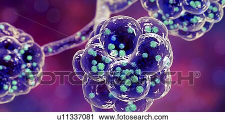 Staphylococcal pneumonia. Computer illustration of Staphylococcus aureus bacteria inside the alveoli of the lungs, causing pneumonia. View Large Photo Image Stock Image - Staphylococcal pneumonia. Computer illustration of Staphylococcus aureus bacteria inside the alveoli of the lungs, causing pneumonia.. Fotosearch