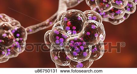 Stock Image - Staphylococcal pneumonia. Computer illustration of Staphylococcus aureus bacteria inside the alveoli of the lungs, causing pneumonia.. Fotosearch