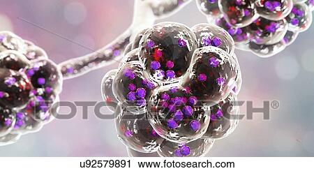 Staphylococcal pneumonia. Computer illustration of Staphylococcus aureus bacteria inside the alveoli of the lungs, causing pneumonia. View Large Photo Image Stock Image - Staphylococcal pneumonia. Computer illustration of Staphylococcus aureus bacteria inside the alveoli of the lungs, causing pneumonia.. Fotosearch