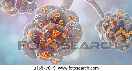 Staphylococcal pneumonia. Computer illustration of Staphylococcus aureus bacteria inside the alveoli of the lungs, causing pneumonia. View Large Photo Image Stock Photo - Staphylococcal pneumonia. Computer illustration of Staphylococcus aureus bacteria inside the alveoli of the lungs, causing pneumonia.. Fotosearch