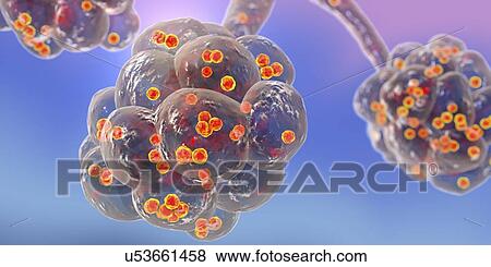 Staphylococcal pneumonia. Computer illustration of Staphylococcus aureus bacteria inside the alveoli of the lungs, causing pneumonia. View Large Photo Image Stock Photo - Staphylococcal pneumonia. Computer illustration of Staphylococcus aureus bacteria inside the alveoli of the lungs, causing pneumonia.. Fotosearch